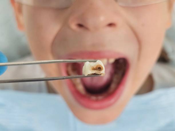 Best Emergency Treatment for Toothache in Kelso, WA