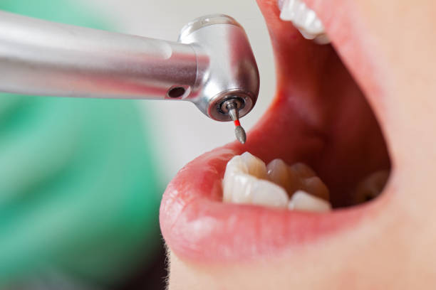 Best Emergency Wisdom Teeth Removal in Kelso, WA